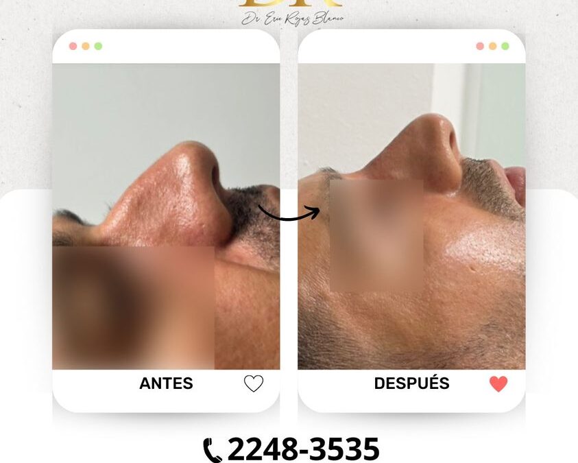 Rinolift, el procedimiento ideal para corregir tu nariz.
