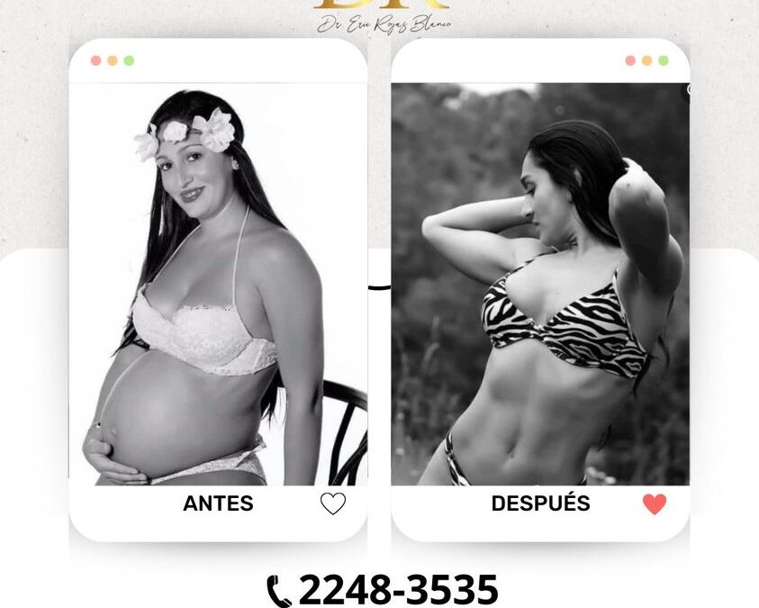 Marcaje Abdominal con Slim Láser, puedes tener el cuerpo que deseas luego de tu bebé.