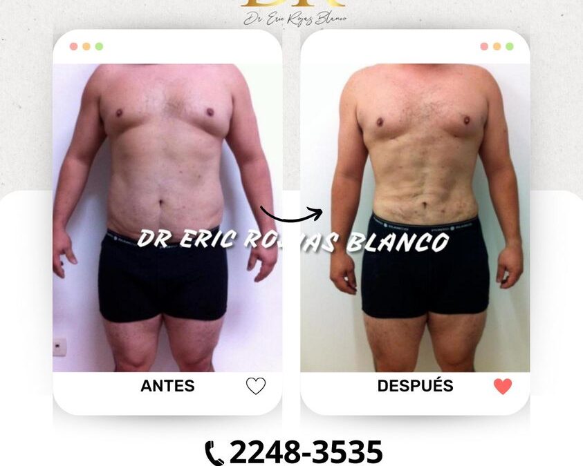Slim Láser, el mejor método para obtener el cuerpo que deseas.