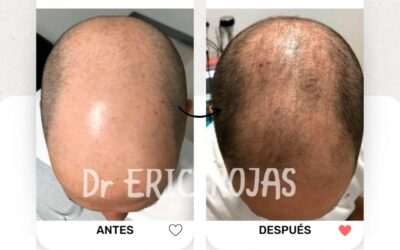 Elimina la alopecia con nuestro tratamiento.