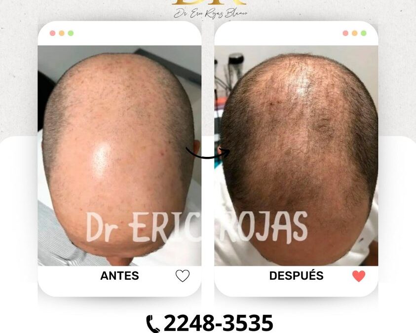 Elimina la alopecia con nuestro tratamiento.