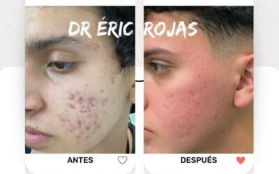 Elimina el acné de tu vida, obtén tu rostro perfecto.