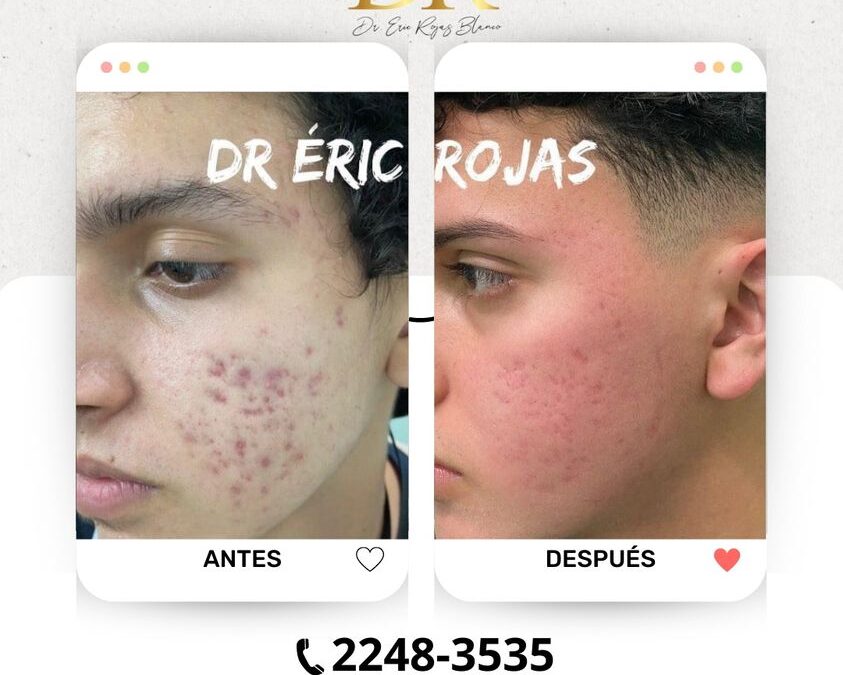 Elimina el acné de tu vida, obtén tu rostro perfecto.
