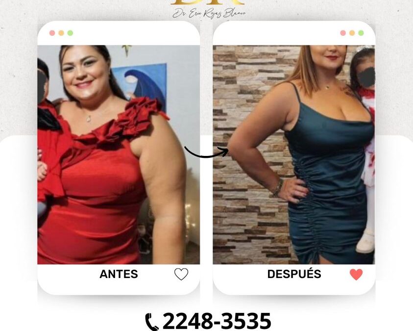 Slim Láser Brazos, resultados increíbles.