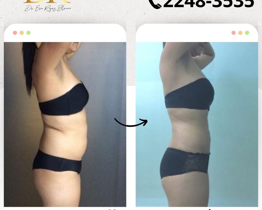 Slim Láser, resultados increíbles.