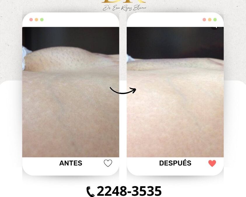 Slim Láser en Pubis, ¿Ya conocías esta técnica?, ¿Quieres estos resultados?, somos tu solución.