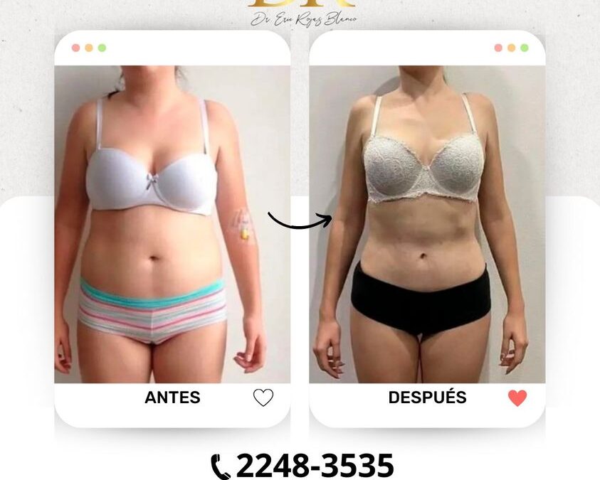 Slim Láser es la técnica ideal para obtener tu cuerpo perfecto.