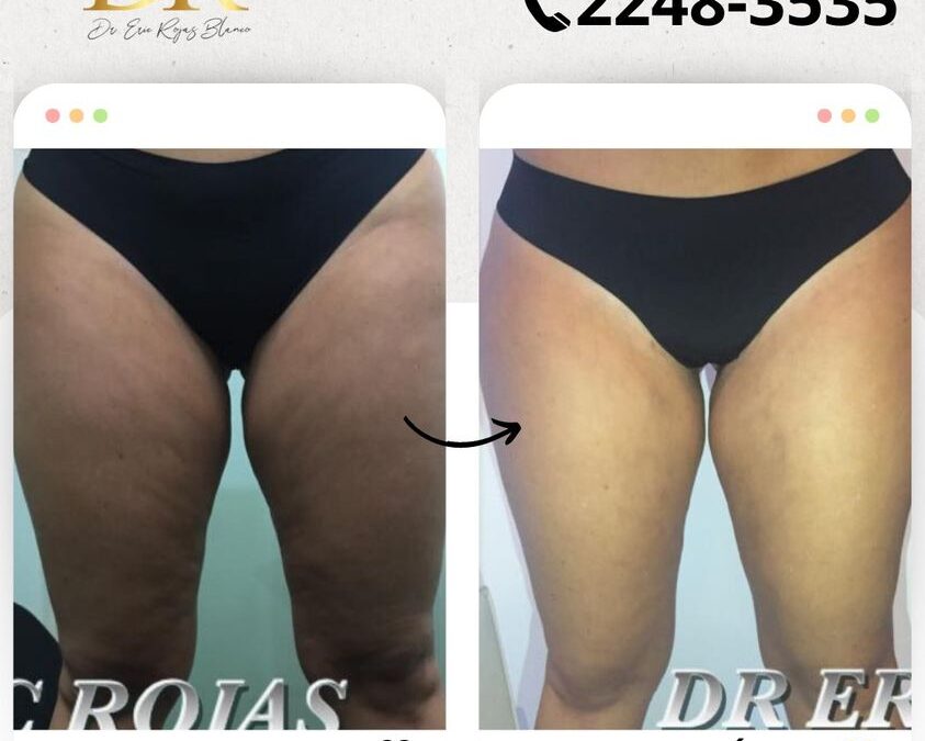 Elimina la celulitis de tu piel con el mejor láser.