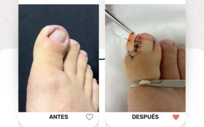 Tratamiento uña encarnada, nosotros solucionamos tu problema.