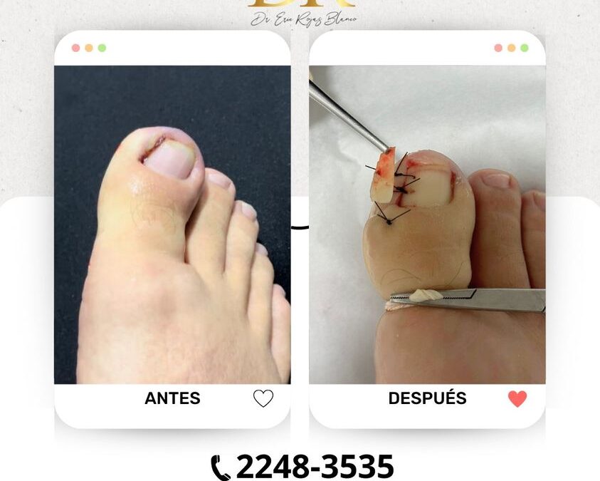 Tratamiento uña encarnada, nosotros solucionamos tu problema.
