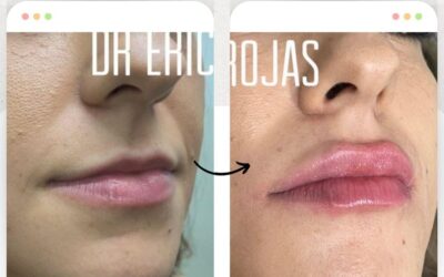 Relleno de labios $399 USD, con la mejor técnica.