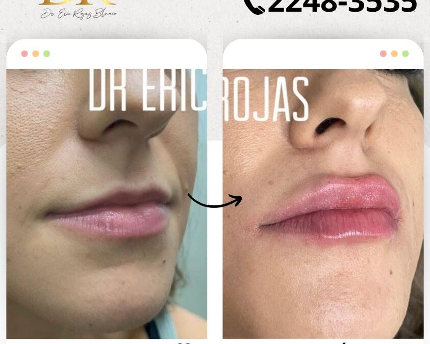 Relleno de labios $399 USD, con la mejor técnica.