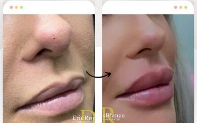 Relleno de labios con Rinolift, resultados increíbles.