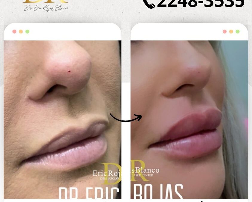 Relleno de labios con Rinolift, resultados increíbles.