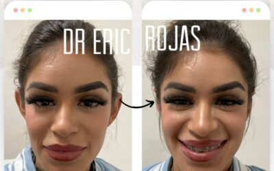 Corrección de orejas, con el mejor procedimiento. 😉👇 Dermo-Otoplastía.