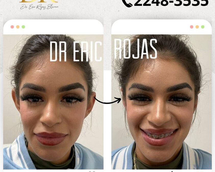 Corrección de orejas, con el mejor procedimiento. 😉👇 Dermo-Otoplastía.