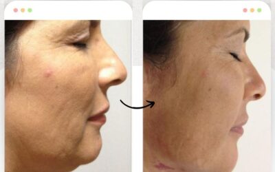 Slim Láser papada con resultados Excelentes.