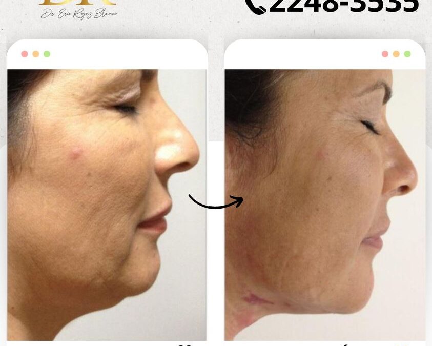 Slim Láser papada con resultados Excelentes.