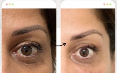 Tenemos los mejores tratamientos para eliminar tus ojeras.