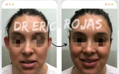 La Dermo Otoplastía te brindará los resultados que deseas.