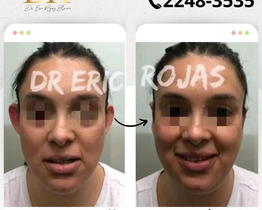 La Dermo Otoplastía te brindará los resultados que deseas.