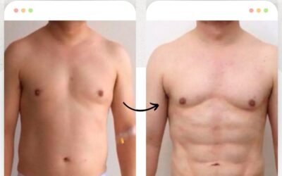 Marcaje abdominal con Slim Láser.