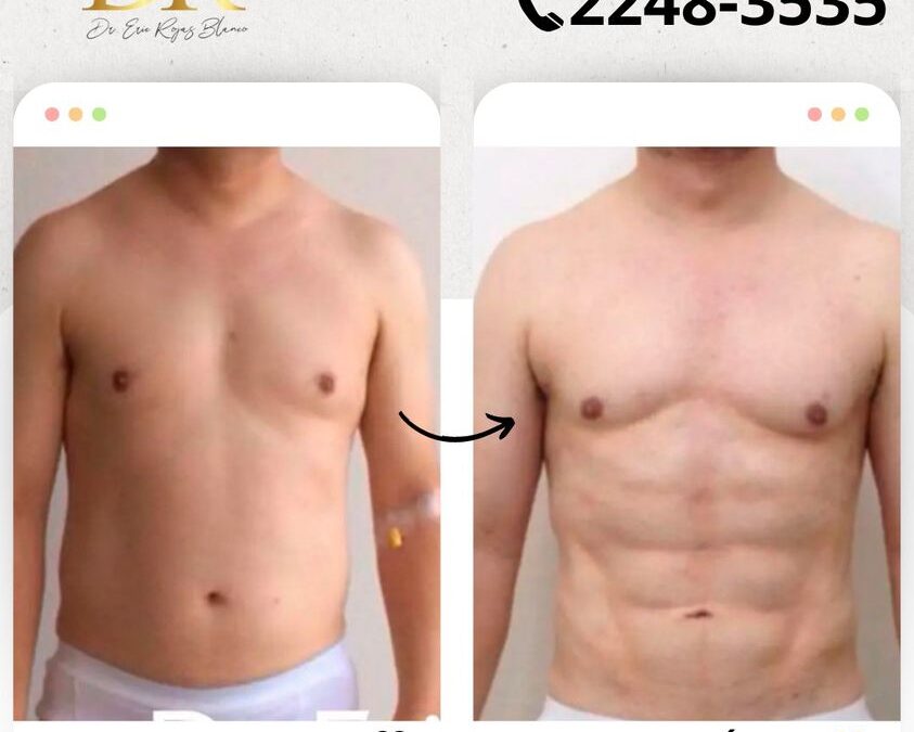 Marcaje abdominal con Slim Láser.