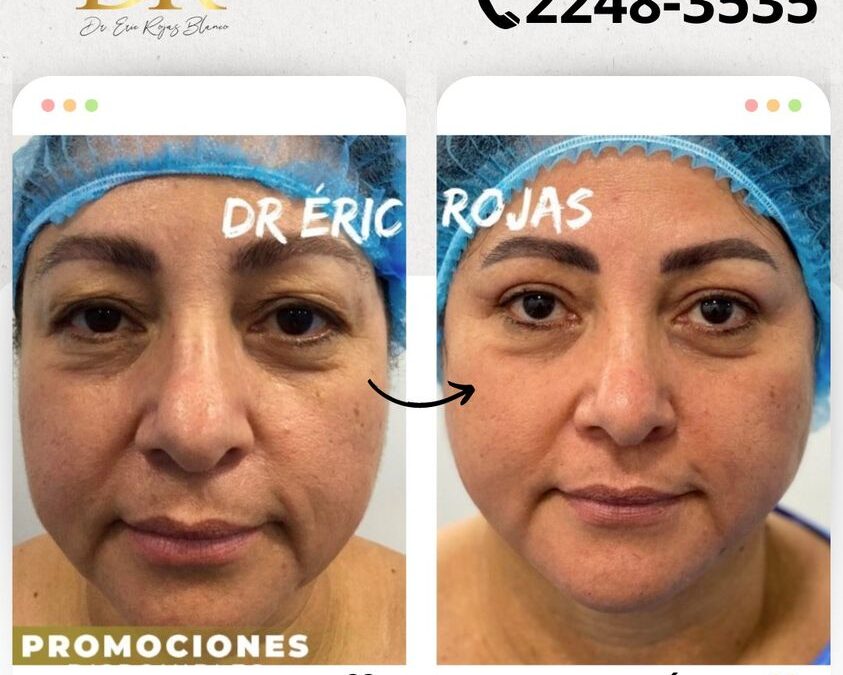 Aprovecha y realizate un refrescamiento facial.