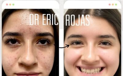 Recupera tu sonrisa y déjanos eliminar tu acné.