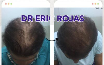 Detén la caída de tu cabello.
