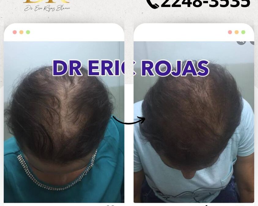 Detén la caída de tu cabello.