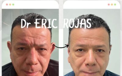 Rejuvenece tu rostro con las mejores técnicas.
