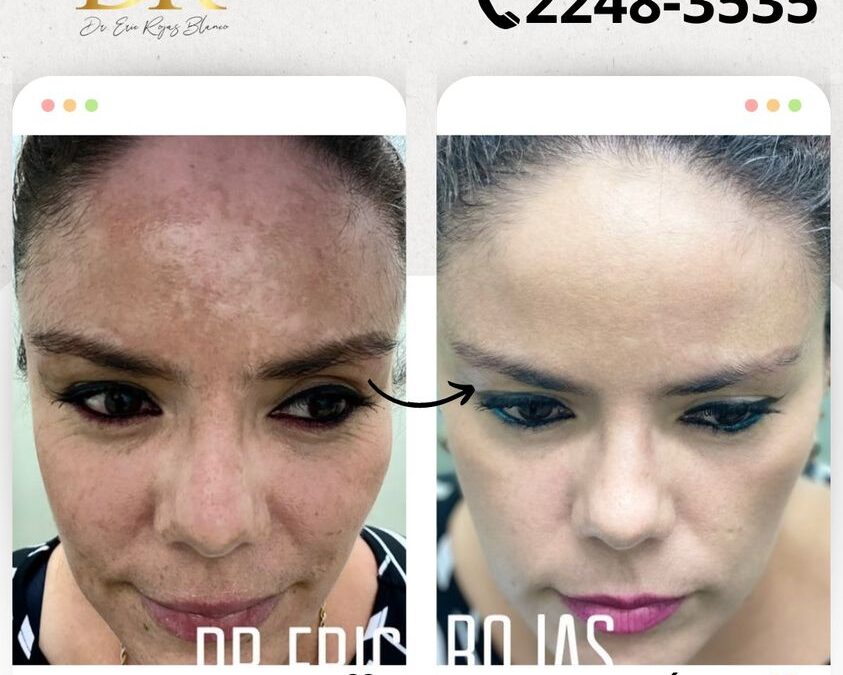 Limpia tu rostro y elimina todas las manchas.