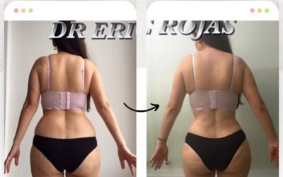 Hermoso resultado de Slim Láser.