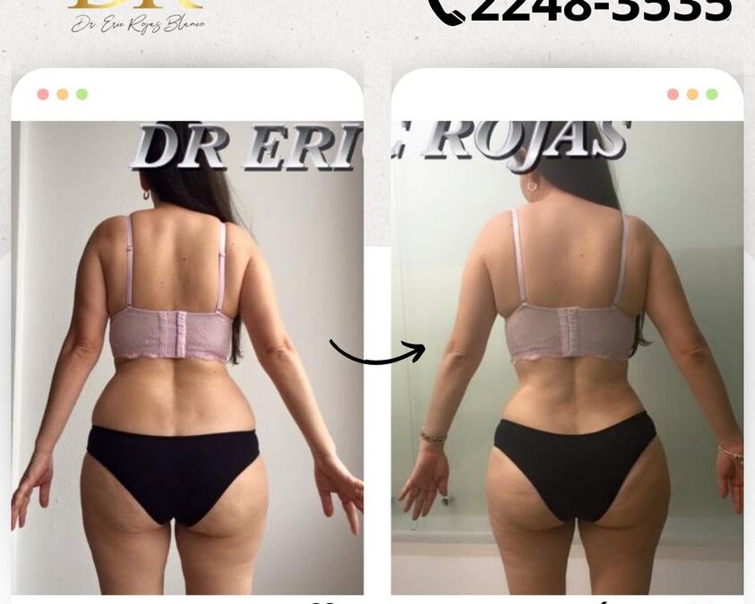 Hermoso resultado de Slim Láser.