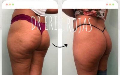 Soluciona la celulitis.