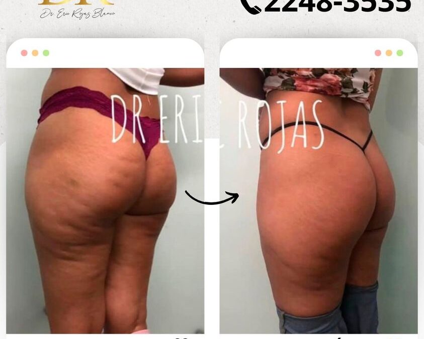 Soluciona la celulitis.
