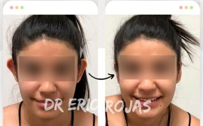 Dermo Otoplastía por tan solo $950 dólares.