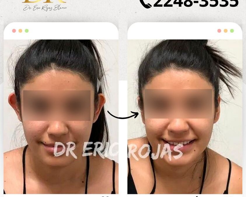 Dermo Otoplastía por tan solo $950 dólares.