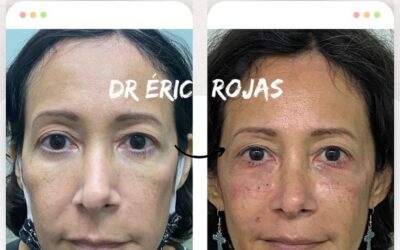 Rejuvenece tu rostro con la mejor técnica en nuestro clínica.