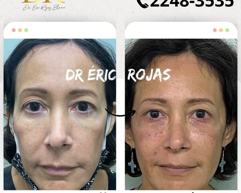 Rejuvenece tu rostro con la mejor técnica en nuestro clínica.
