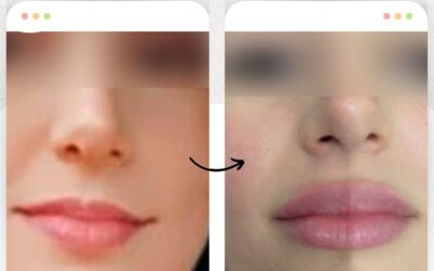 Relleno de labios en tan solo $399 USD.