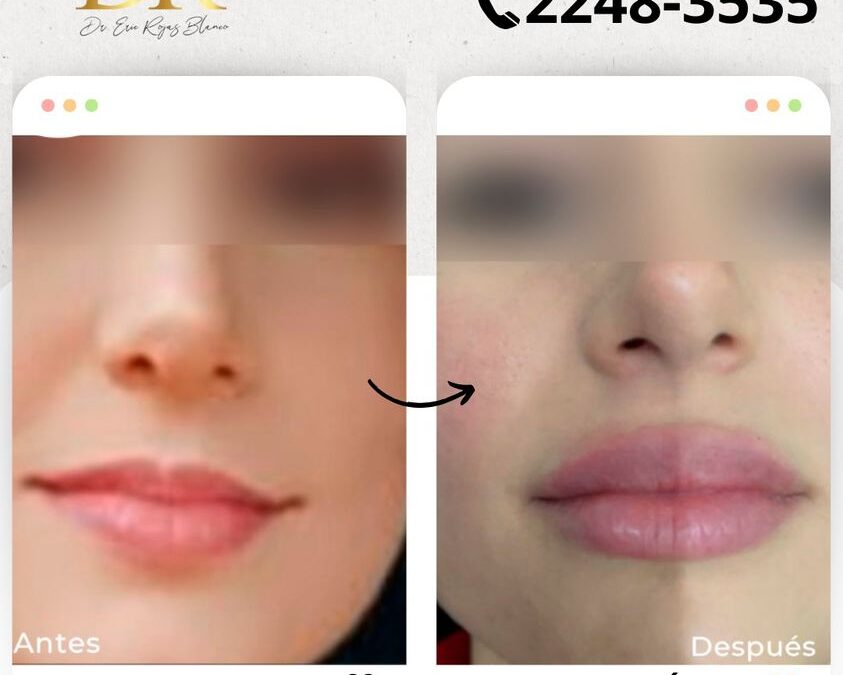 Relleno de labios en tan solo $399 USD.