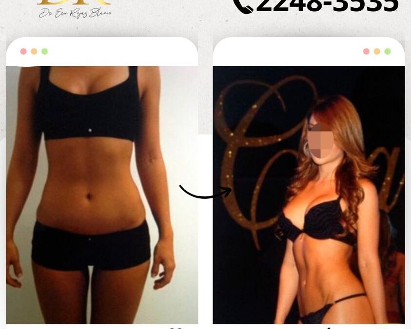 Slim Láser para crear cuerpos increíbles.