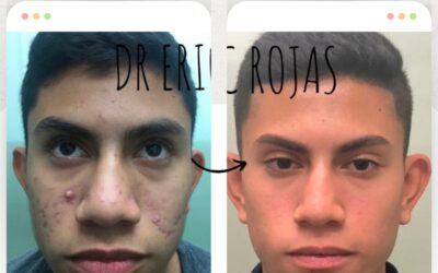 ¿Eliminar el acné de tu rostro?, Somos EXPERTOS.