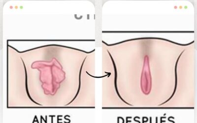 Dermo Labioplastía, por solo $750 dólares por el mes de la patria.