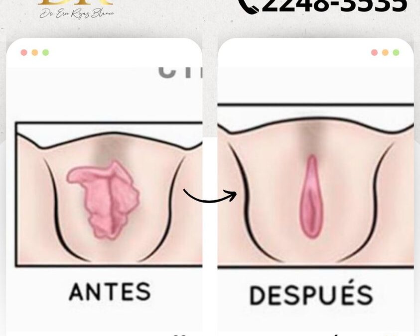 Dermo Labioplastía, por solo $750 dólares por el mes de la patria.