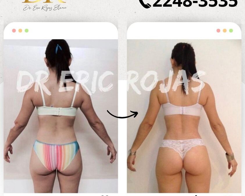 Slim Láser, los cambios más increíbles los logramos.