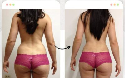 Slim láser, resultados impresionantes.
