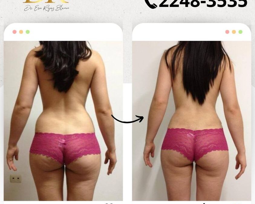 Slim láser, resultados impresionantes.